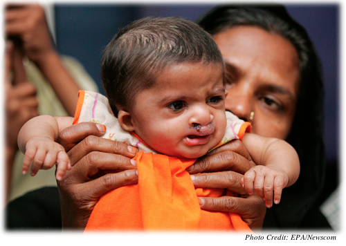 Nida, a 7-month-old girl with a congenital birth defect, with her mother at a press conference in New Delhi, India on April 29, 2008.  