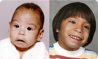 This is John, who was born with fetal alcohol syndrome (FAS), at age 4 months and 5 years.