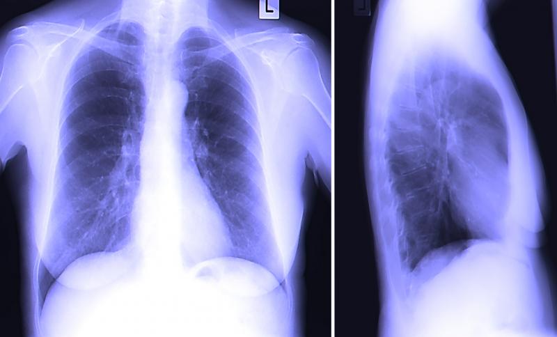 A set of two X-ray films, one shows the front view of the chest and the other shows the side view.