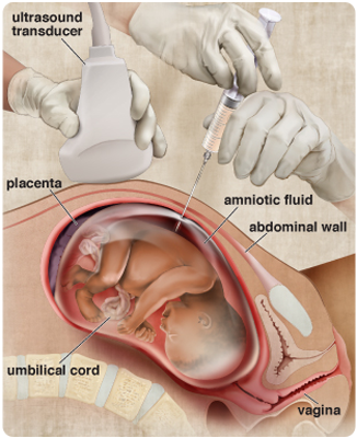 Diagram of an amniocentesis procedure.  An ultrasound probe is used to locate the fetus and amniotic fluid within the womb and a needle is inserted to withdraw a sample of amniotic fluid for testing.