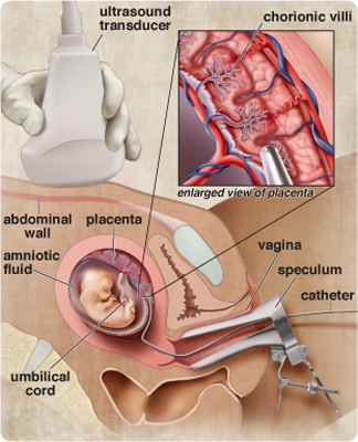 Diagram of chorionic villus sampling.  An ultrasound probe is used to locate the fetus within the womb and a catheter is inserted to guide an instrument into the uterus to withdraw a sample of placenta for testing.