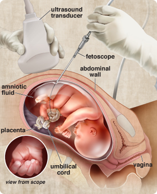 Diagram of a fetoscopy procedure.  An ultrasound probe is used to locate the fetus within the womb and a fetoscope is inserted through the abdomen to take images of the fetus.