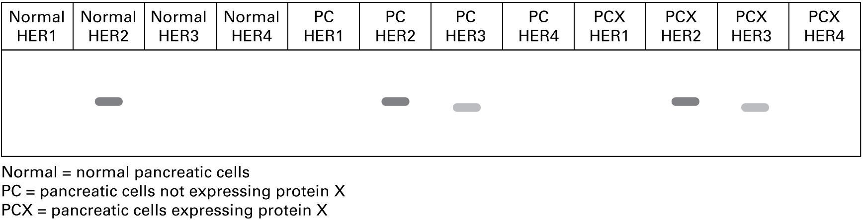 RT-PCR results show the following lanes and bands: Normal pancreatic cells and RT-PCR using primers for HER1: no band Normal pancreatic cells and RT-PCR using primers for HER2: band Normal pancreatic cells and RT-PCR using primers for HER3: no band Normal pancreatic cells and RT-PCR using primers for HER4: no band Pancreatic cells not expressing protein X and RT-PCR using primers for HER1: no band Pancreatic cells not expressing protein X and RT-PCR using primers for HER2: band Pancreatic cells not expressing protein X and RT-PCR using primers for HER3: band Pancreatic cells not expressing protein X and RT-PCR using primers for HER4: no band Pancreatic cells expressing protein X and RT-PCR using primers for HER1: no band Pancreatic cells expressing protein X and RT-PCR using primers for HER2: band Pancreatic cells expressing protein X and RT-PCR using primers for HER3: band Pancreatic cells expressing protein X and RT-PCR using primers for HER4: no band 
