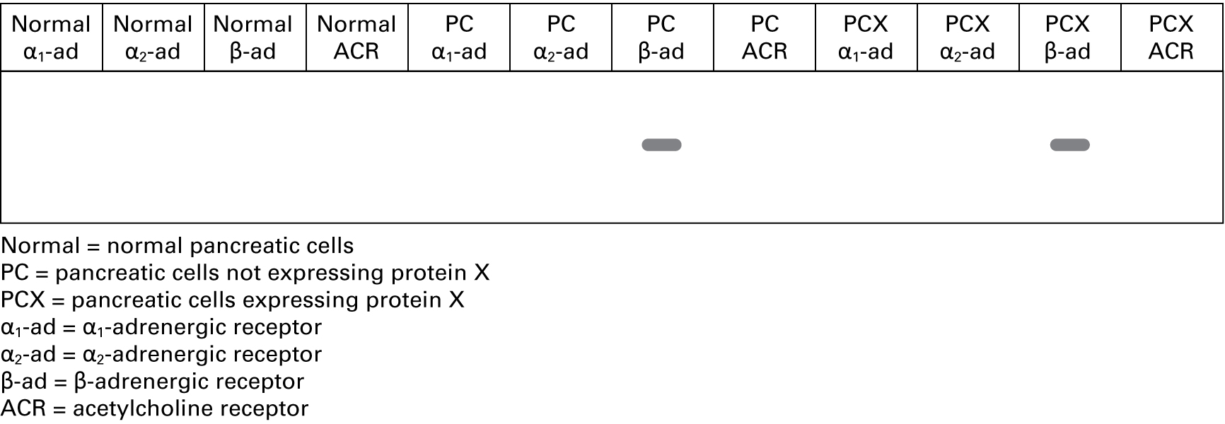 RT-PCR results show the following lanes and bands: Normal pancreatic cells and RT-PCR using primers for α1-adrenergic receptor: no band Normal pancreatic cells and RT-PCR using primers for α2-adrenergic receptor: no band Normal pancreatic cells and RT-PCR using primers for β-adrenergic receptor: no band Normal pancreatic cells and RT-PCR using primers for acetylcholine receptor: no band Pancreatic cells not expressing protein X and RT-PCR using primers for α1-adrenergic receptor: no band Pancreatic cells not expressing protein X and RT-PCR using primers for α2-adrenergic receptor: no band Pancreatic cells not expressing protein X and RT-PCR using primers for β-adrenergic receptor: band Pancreatic cells not expressing protein X and RT-PCR using primers for acetylcholine receptor: no band Pancreatic cells expressing protein X and RT-PCR using primers for α1-adrenergic receptor: no band Pancreatic cells expressing protein X and RT-PCR using primers for α2-adrenergic receptor: no band Pancreatic cells expressing protein X and RT-PCR using primers for β-adrenergic receptor: band Pancreatic cells expressing protein X and RT-PCR using primers for acetylcholine receptor: no band 