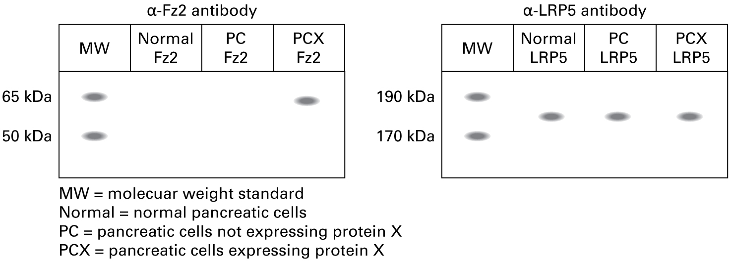 Western blot using the anti-Fz2 antibody shows the following lanes and bands: Normal pancreatic cells: no band Pancreatic cells not expressing protein X: no band Pancreatic cells expressing protein X: band approximately 63 kDa Western blot using the anti-LRP5 antibody shows the following lanes and bands: Normal pancreatic cells: band approximately 179 kDa Pancreatic cells not expressing protein X: band approximately 179 kDa Pancreatic cells expressing protein X: band approximately 179 kDa 