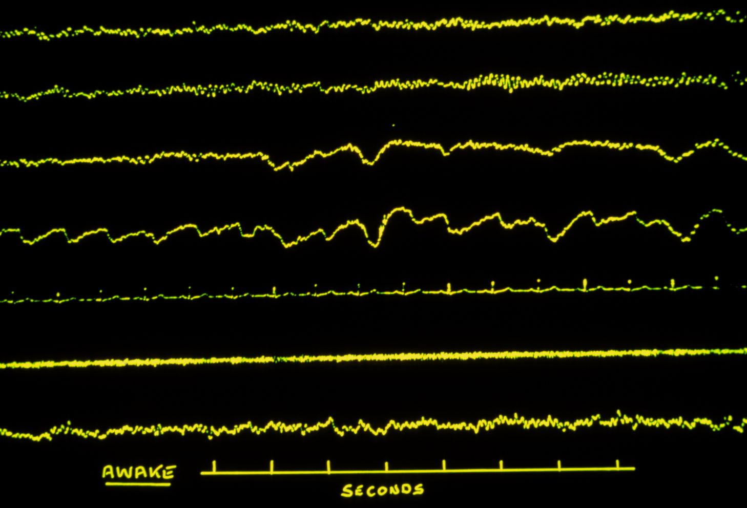 Sleep research: various traces of subject awake M872/0116 Rights Managed Credit: JAMES HOLMES/SCIENCE PHOTO LIBRARY Caption: Sleep research: series of false-colour traces showing typical brain & muscle activity in a subject who is awake. Numbered from top to bottom, 1 & 2 are electroencephalograms (EEG) of brain activity; 3 is an electrooculogram (EOG) of movement in the right eye; 4 an EOG of the left eye; 5 is an electrocardiogram (ECG) trace of heart activity. Finally, 6 & 7 are electromyograms (EMG) showing activity in the laryngeal (6) and neck (7) muscles. Sleep comprises cycles of 5 distinct stages; 1-4 are stages of increasingly deeper sleep known as non-rapid eye movement (NREM), and a 5th stage of lighter, rapid eye movement (REM) sleep.