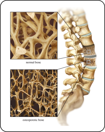 A drawing of the spine with close-up inserts showing the density of healthy bone as compared to bone from osteoporosis (called osteoporotic bone).  Healthy bone has a very thick honeycomb look.  Osteoporotic bone is much thinner, less dense, and looks much weaker.