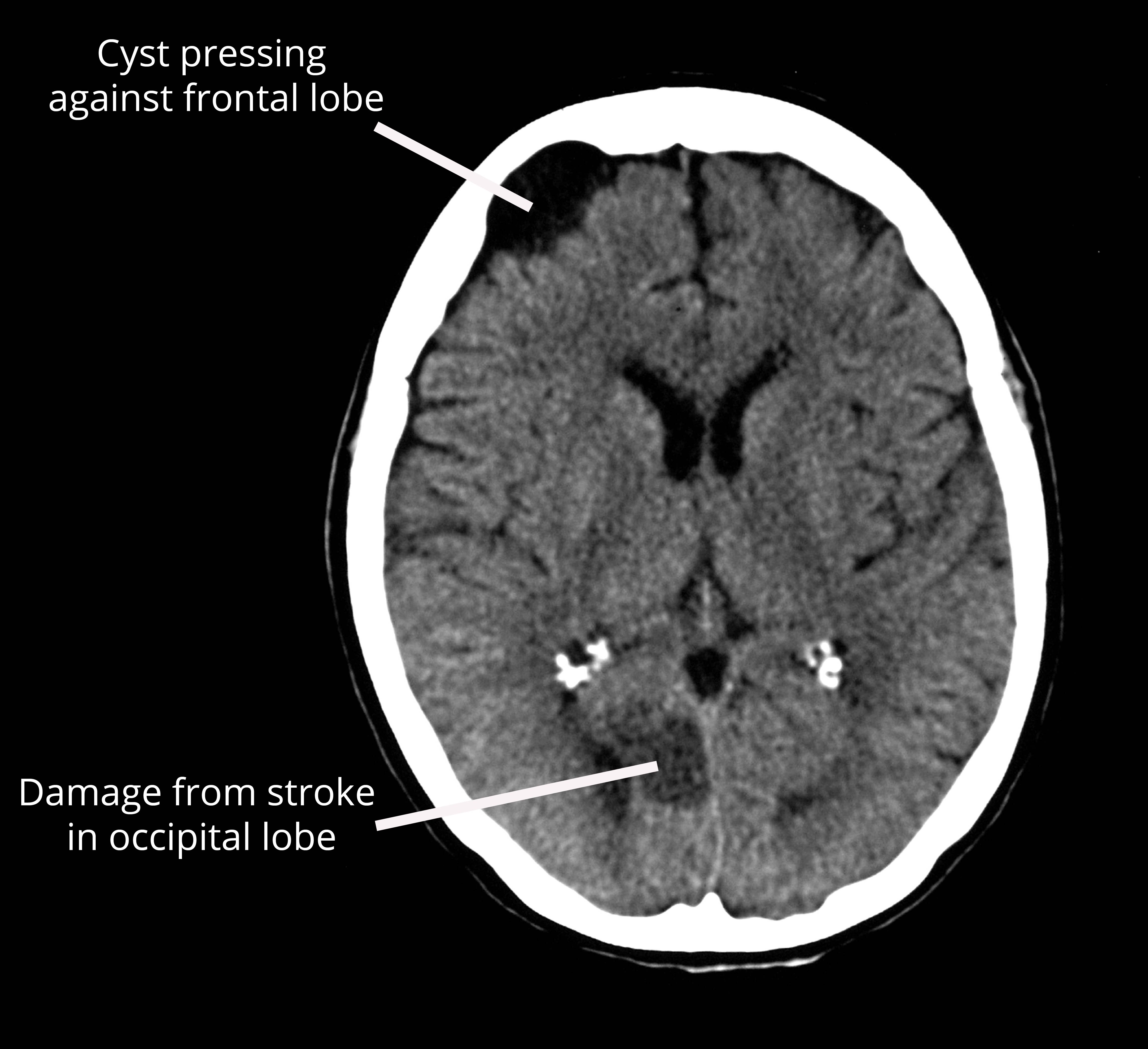 The image is a black and white x-ray photograph of the brain.  It shows a horizontal slice of the brain, where the skull is white and the inside of the brain is gray.  A large black mass at the front of the brain represents a cyst pressing against the frontal lobe.  A fuzzy dark gray mass near the back of the brain represents damage from a stroke in the occipital lobe. 