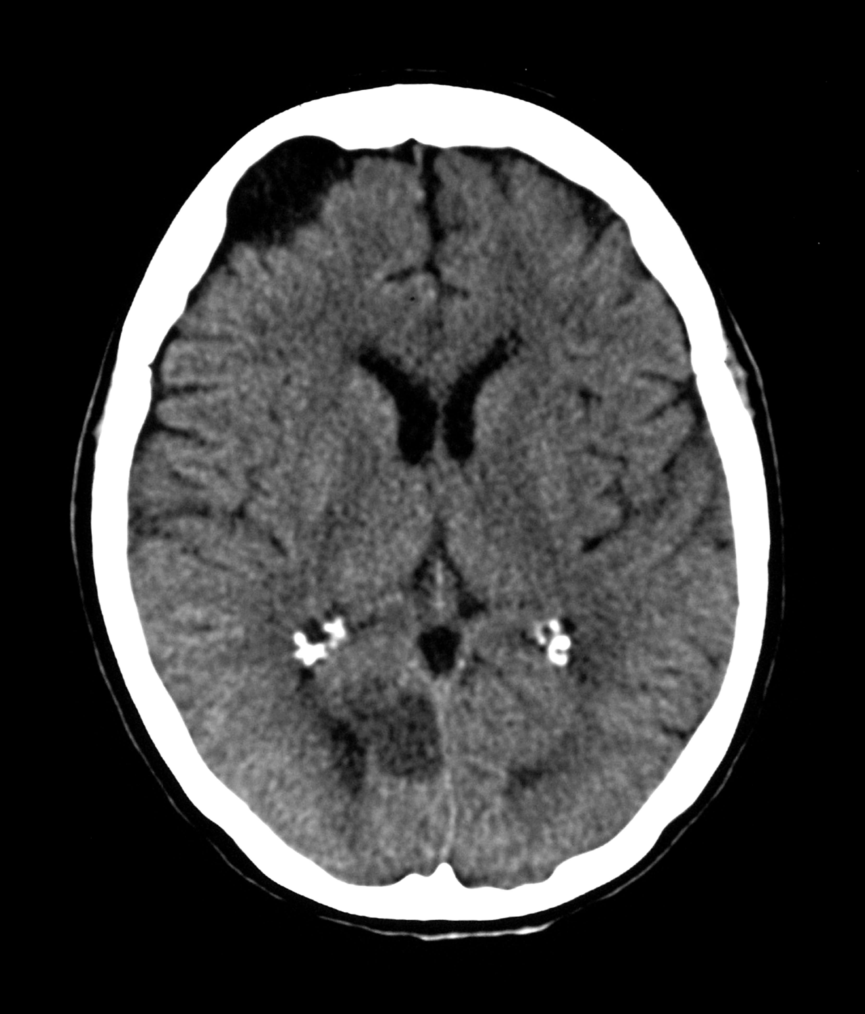 This axial (cross sectional) CT of the head in a person with the sudden onset of visual loss shows a typical infarct in the right (on your left) occipital lobe. Incidentally noted is a typical arachnoid cyst in the right frontal region with bony remodellin