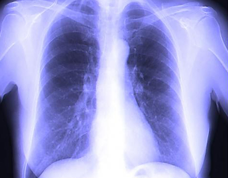 A set of two X-ray films, one shows the front view of the chest and the other shows the side view.