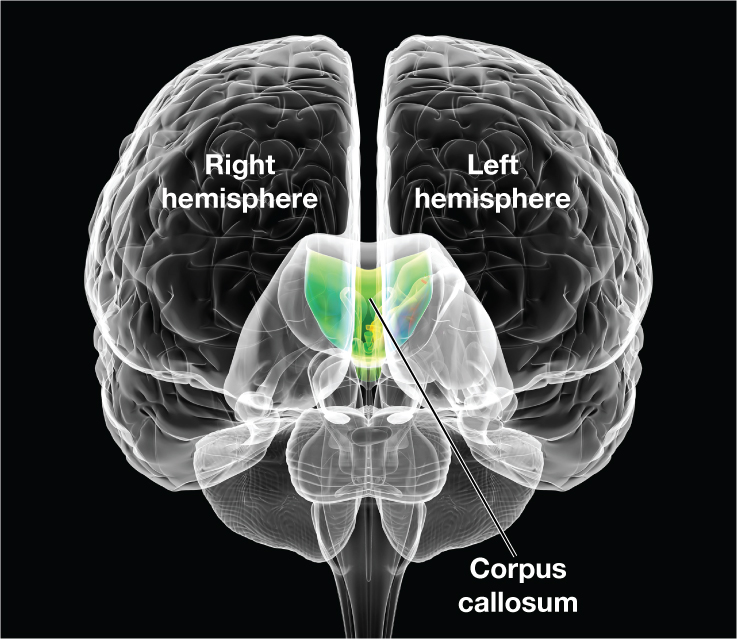 An illustration of the human brain shows the right hemisphere, left hemisphere, and corpus callosum. The corpus callosum connects the right and left hemispheres of the brain. 